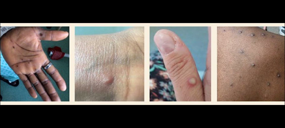 Examples of monkeypox infections